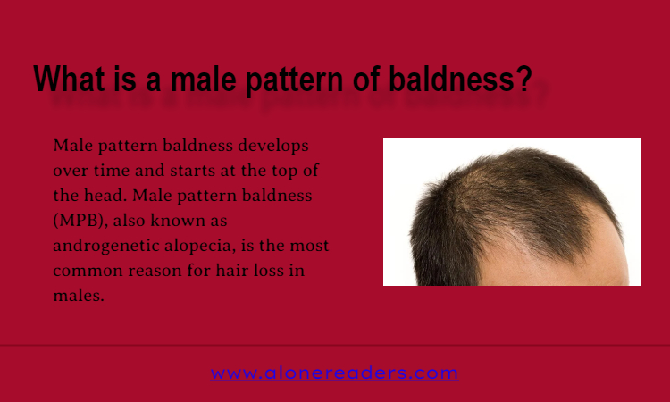 What is a Male Pattern of Baldness? - AloneReaders.com